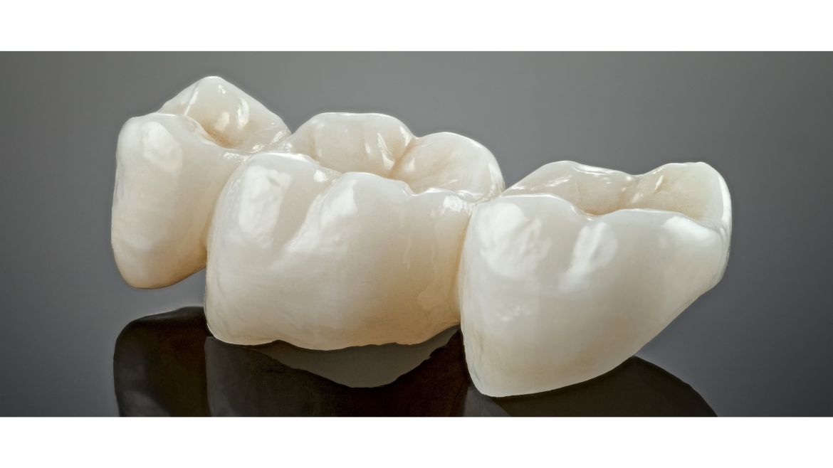 Zahnbrücke bestehend aus drei Kronen