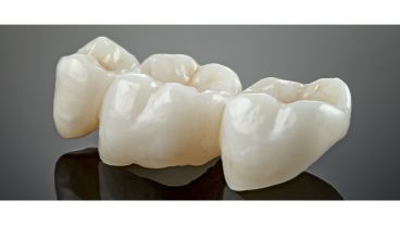 Zahnbrücke bestehend aus drei Kronen